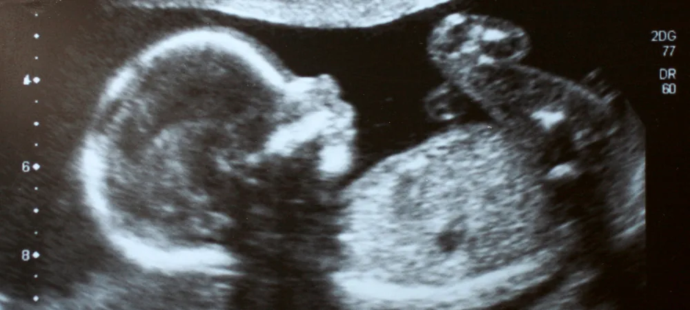 Ultrasound image of a fetus during pregnancy